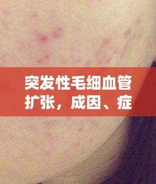 突发性毛细血管扩张,成因、症状及治疗方案一网打尽!