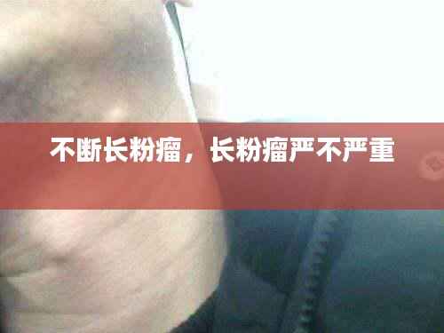 不断长粉瘤,长粉瘤严不严重